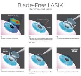 LASIK Seattle | LASIK Eye Surgery Tacoma | Evergreen Eye